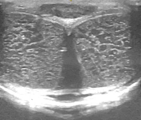 Penis ultrasound