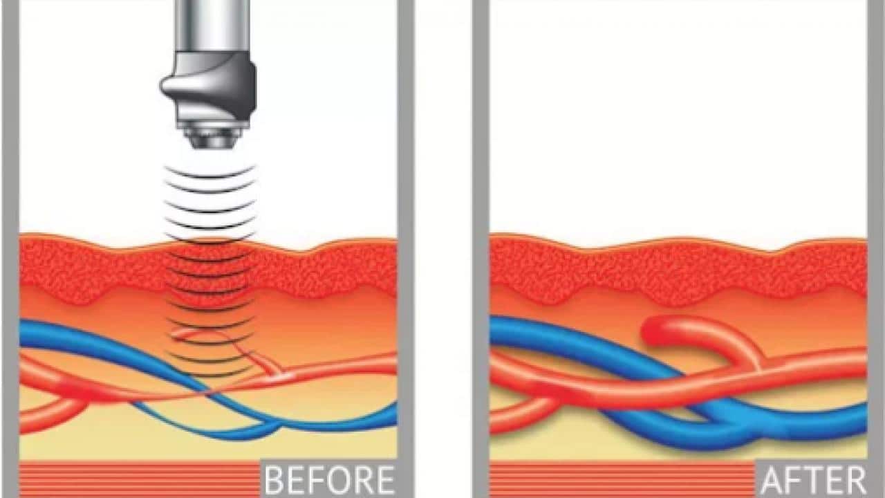 Shockwave Therapy Diagram