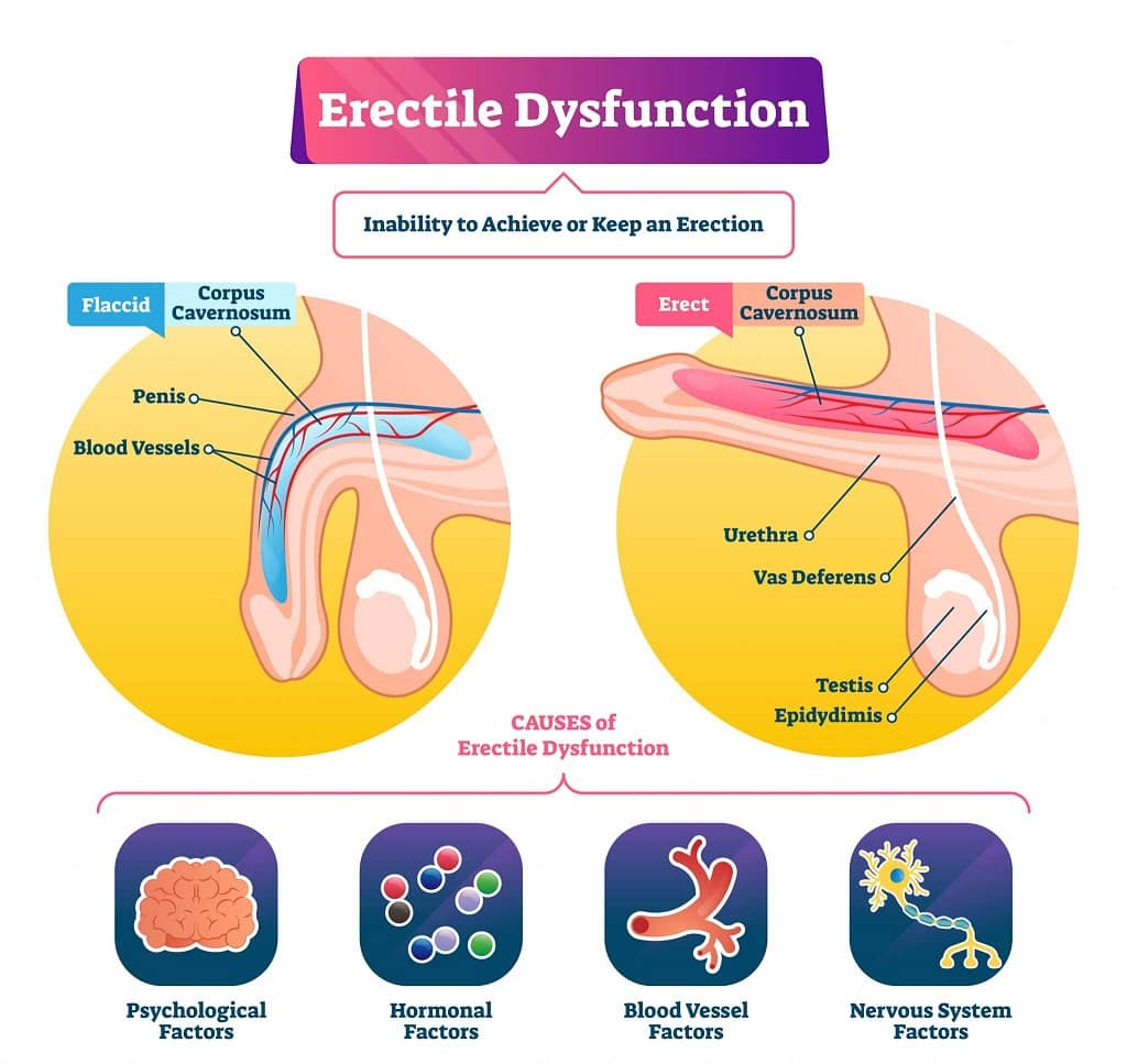 Erectile dysfunction infographic