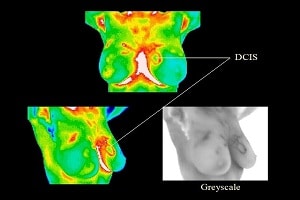 Thermography breasts